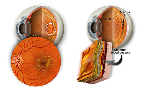 Žućkaste mrlje (drusen) koje se formiraju u pozadini oka ili retine su rani znak suve makularne degeneracije. Vlažna makularna degeneracija se događa sa formacijom abnormalnih krvnih sudova i curenjem u pozadini oka (retine), što utiče na makulu gde se događa fino fokusiranje.