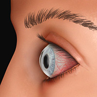 Keratoconjunctivitis sicca odnosi se na suvoću oka koja pogađa rožnjaču i konjuktive.