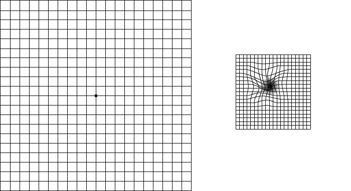 Amslerova mreža se sastoji od pravih linija sa referentnom tačkom u sredini. Neko sa makularnom degeneracijom može videti neke od linija kao izvijugane ili mutne, sa crnim predelom u centru.